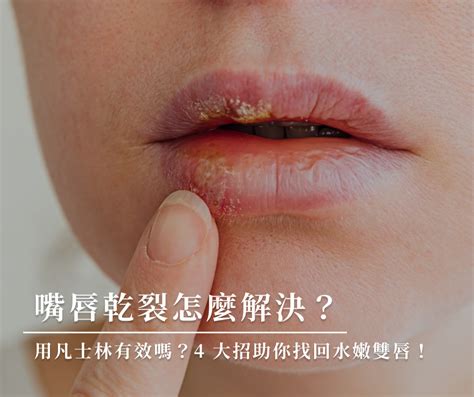 嘴唇|如何擺脫嘴唇乾裂、脫皮？告訴你嘴唇乾裂的11種原因…